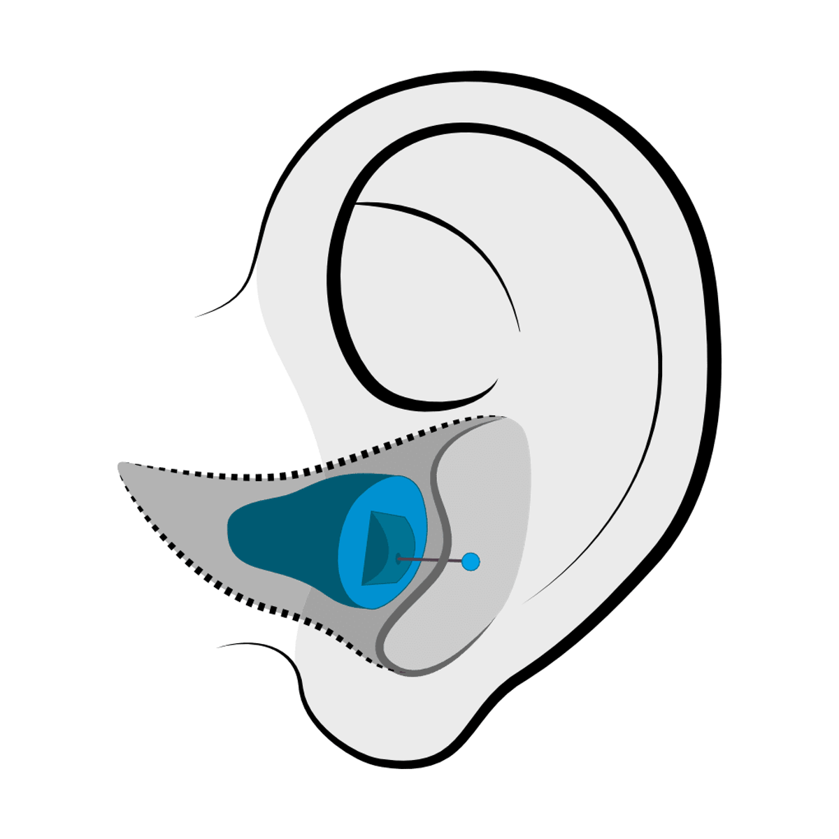 Invisible-in-Canal (IIC) hearing aid style fitted at Hear Today Hearing Aids in Corpus Christi, TX